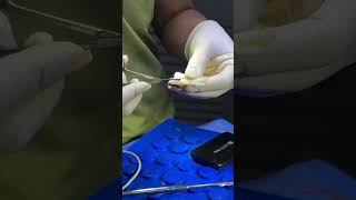 Proper Carving Of The Irradiated Dermis For Nasal Bridge Augmentation