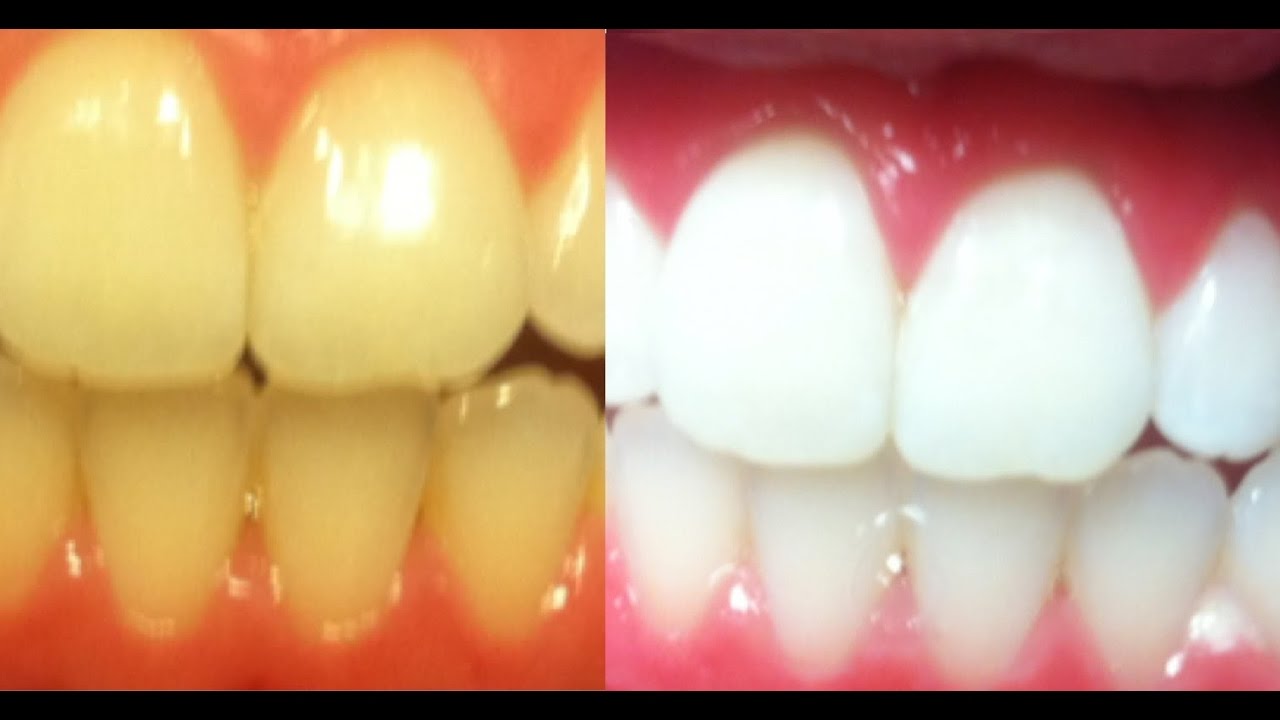 Teeth Whitening At Home in 3 Minutes How To Whiten Yellow Teeth at