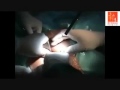 Single port laparoscopic surgery dr b ramesh