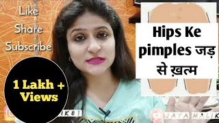 Butt (hips)Acne (दाने) कैसे ठीक करें | Hips Ke pimples hatane ke ghrelu nuskhe | Butt Acne Removal
