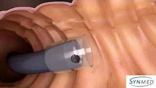 ENDOSCOPIC DISTAL ATTACHMENT CAP FOR EMR, ESD, POEM & ASSOCIATED ENDOSCOPY PROCEDURES