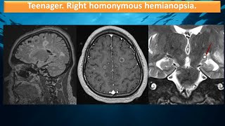 Teenager. Homonymous hemianopsia