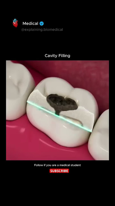 Cavity Filling 🦷 #medical #medicalanimations #medicalstudent #dental #reggae #music #newmusic
