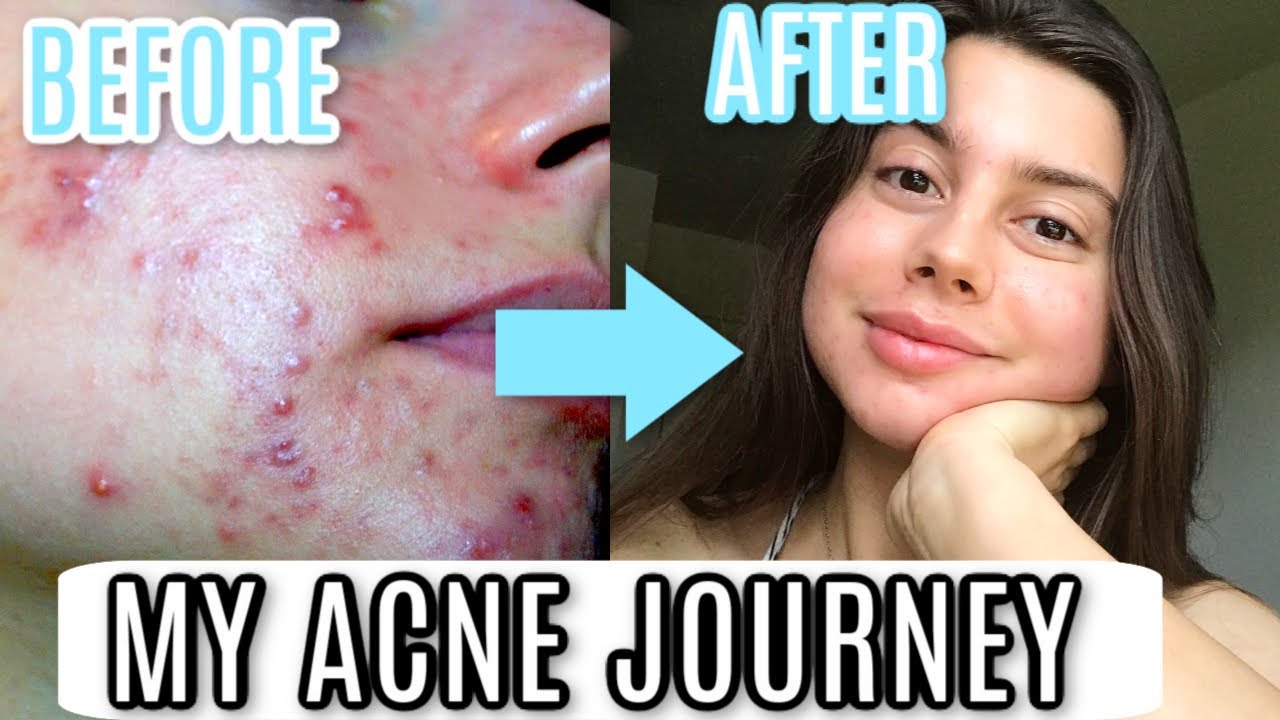 My Acne Journey Story How I Cleared My Skin Everything You Need To