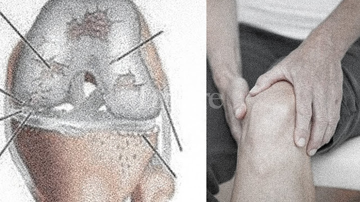 Si të kuptoni se po vuani nga artroza! | Dritarja e doktorit