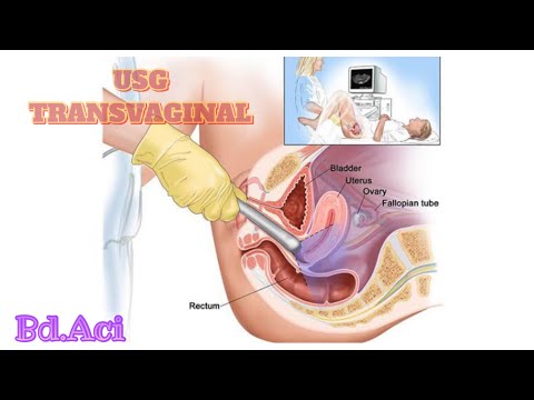 Video: Ultrasonografi Transvaginal: Tujuan, Prosedur, Dan Hasil