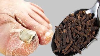 Cure Toenail Fungus For Less Than $1 / Have Toenail Fungus You must do it