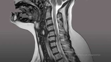 3D Precision Diagnostics: Cervical Spine Injuries MRI