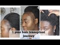 My 1 Year Hair Transplant Journey