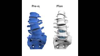Carlsmed: Aprevo AI-enabled 3D Surgical Planning and patient specific devices