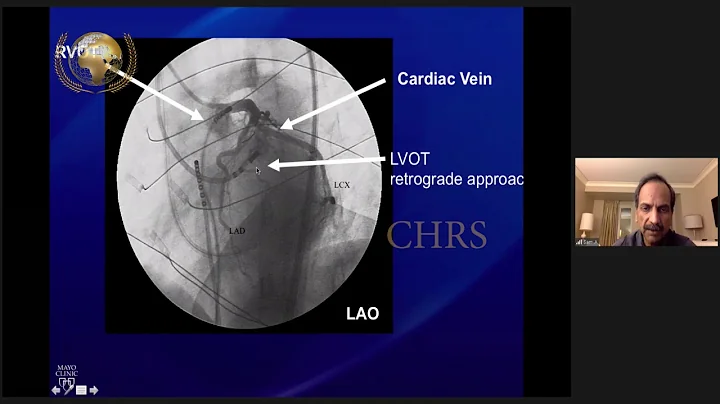 Idiopathic VT in structurally normal heart-Diagnos...