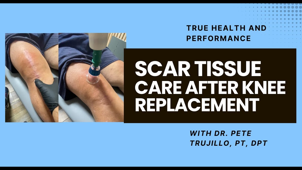 Recover Faster: How Cupping & Scar Massage Help After Knee Replacement ...