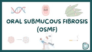Oral Submucous Fibrosis (OSMF): A Comprehensive Guide for Dental Students