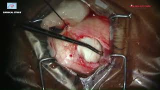 Inferior Oblique Recession Dr. Deepti Joshi