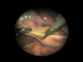 Spiral-type cystic duct–common hepatic duct CHD junction