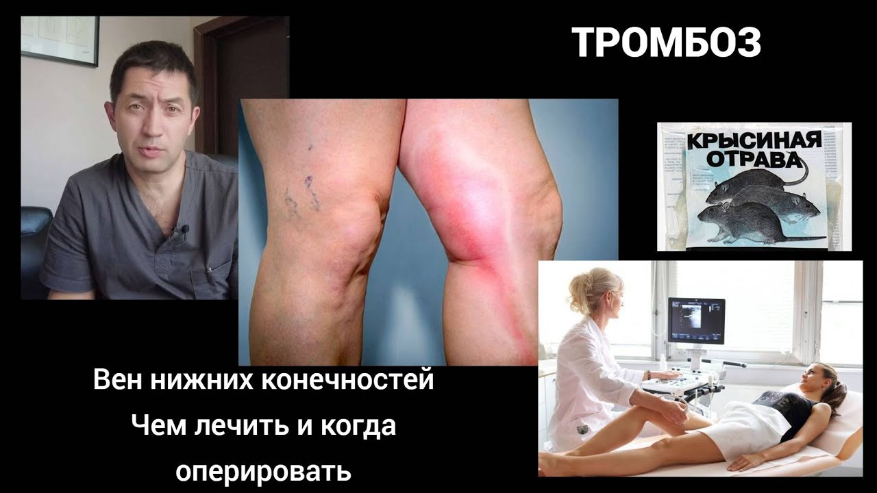 Тромбоз вен нижних конечностей симптомы фото