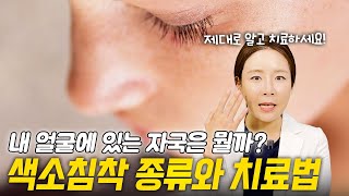 얼굴 피부, 다양한 색소침착 종류와 없애는법은?
