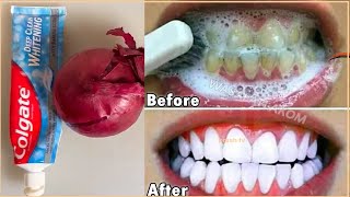Onion peel in 3 minutes natural teeth whitening at home / at home teeth whitening with Onion peel