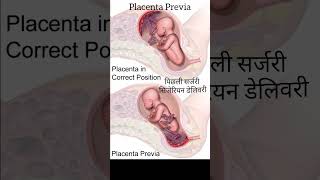 placentaprevia pregnancy vaginalbleeding heavybleeding secondtrimester care tips