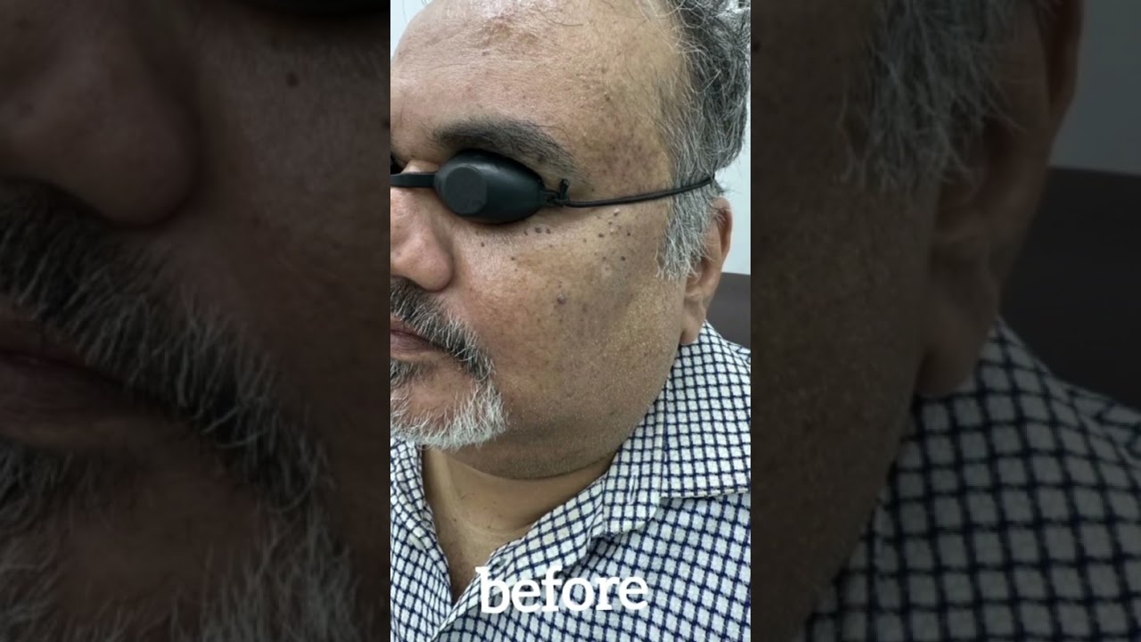 WART REMOVAL BY CAUTERISATION AND LASER TREATMENT WART REMOVAL BY CAUTERISATION AND LASER TREATMENT