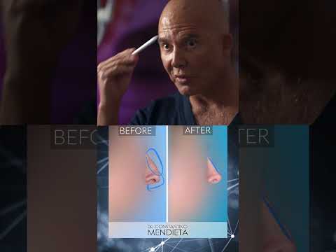Video thumbnail: Nose surgery with Dr. Mendieta | Call Us: 305-680-5811 #miamiplasticsurgery · 4 Beauty Aesthetics Institute, Inc. - Constantino G. Mendieta, MD, FACS