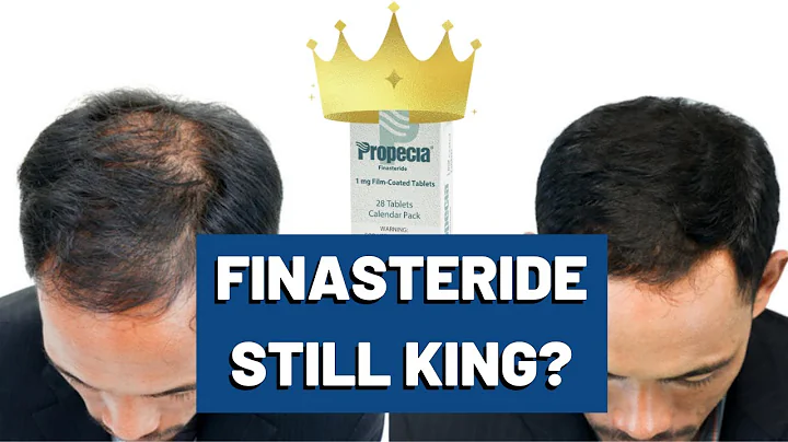 Finasteride - KING of Hair Loss? - DayDayNews