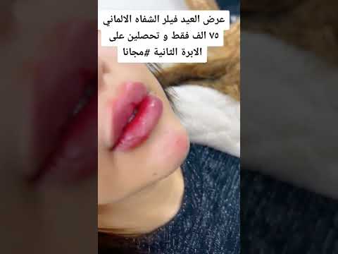 عرض العيد فيلر الشفايف الألماني بسعر ٧٥ الف فقط والثانيه مجانا عند مجمع النور الطبي فقط