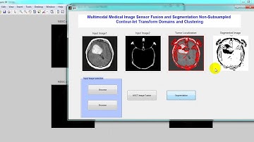 Multimodal Medical Image Fusion Under Nonsubsampled Contourlet Transform Domain