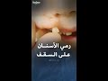 رمي الأسنان على السقف تقليد قديم في الثقافة اليونانية