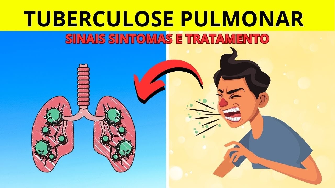 8 Sinais e Sintomas Da Tuberculose Pulmonar, que você precisar ficar ...