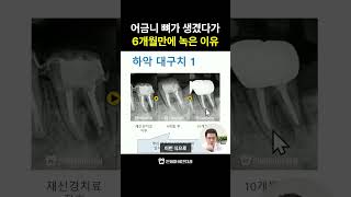 어금니 신경치료 후 염증 재발, 원인은 크랙이었습니다