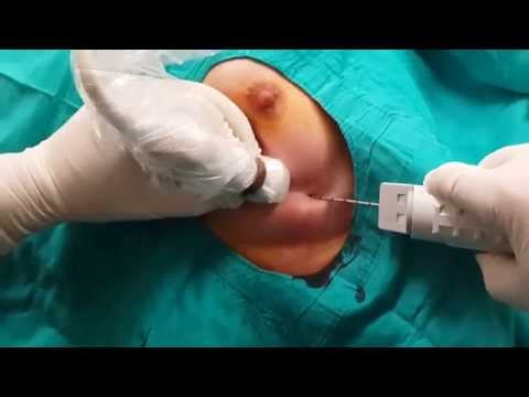 ULTRASOUND GUIDED BREAST BIOPSY