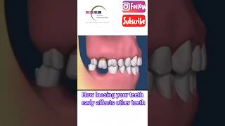 How losing teeth EARLY affects OTHER TEETH in the mouth? #noteeth #missingteeth #dentist