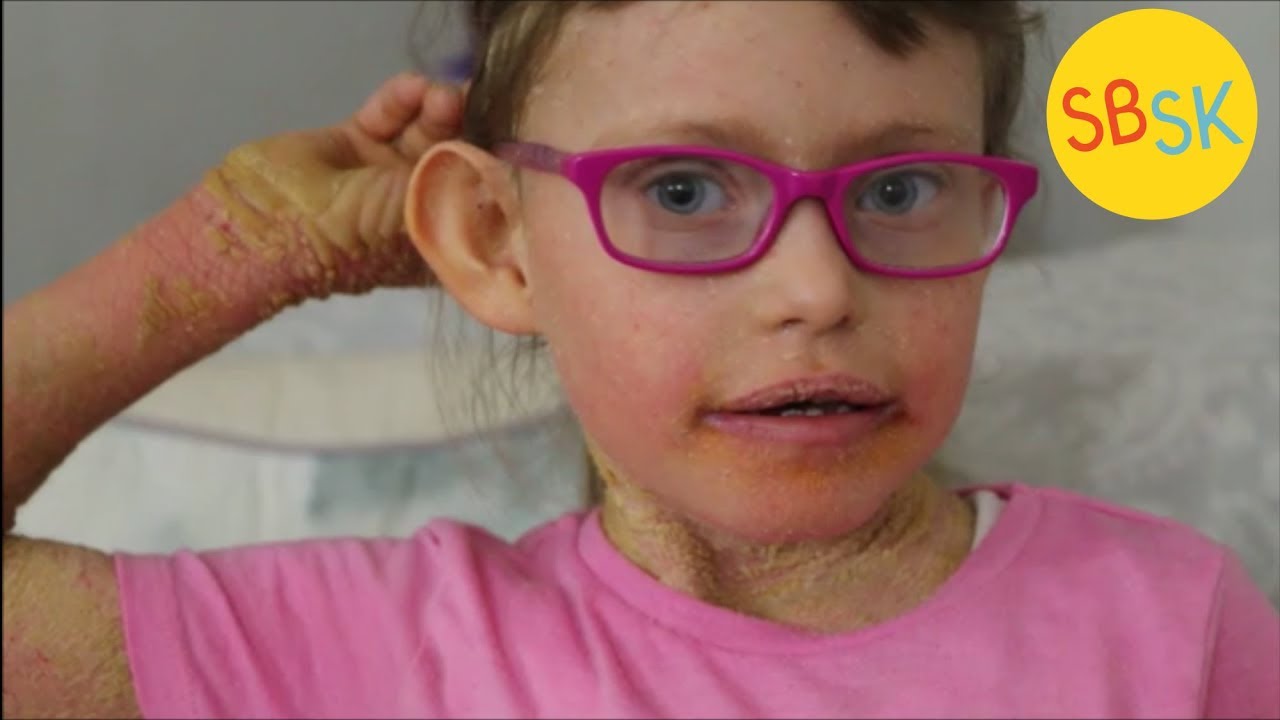 living with scaly skin ichthyosis youtube