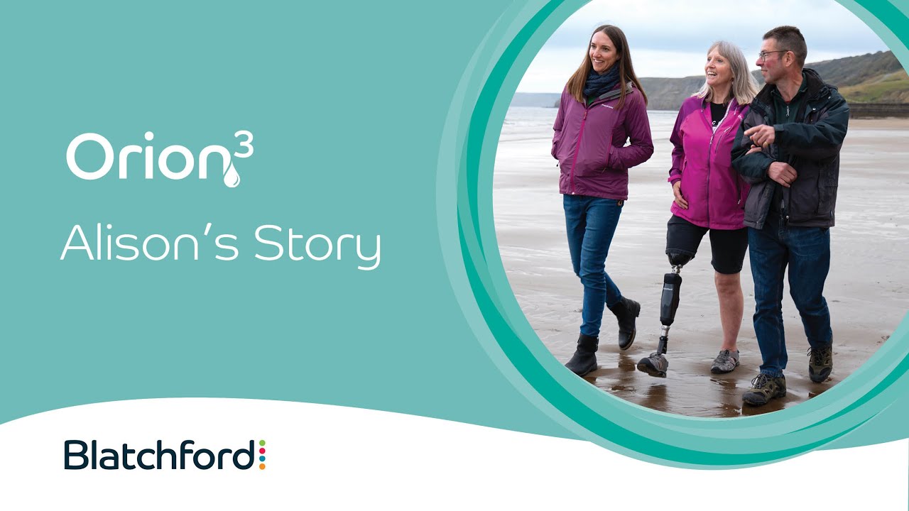 Everyday Life With an Above Knee Prosthetic | Alison’s Orion 3 Amputee Story