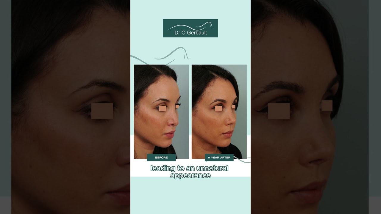 Secondary ultrasonic rhinoplasty