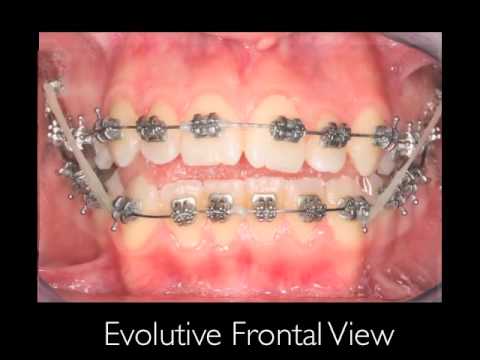 Orthodontic Open bite Movie Collection