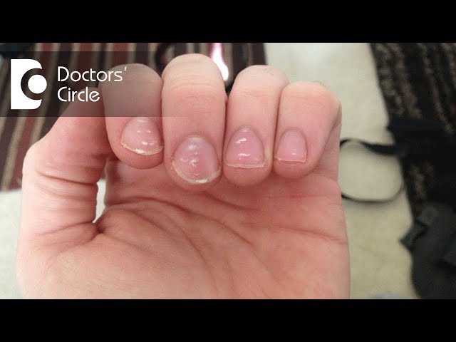 Nail Dystrophy With Ridging and Roughness - Clinical Advisor