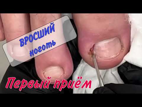 💥Вросший ноготь / 💥врастающий ноготь / 📍подолог Москва