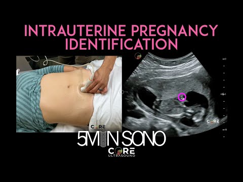 Image of Intrauterine Pregnancy Identification with Point-of-Care Ultrasound (5MS)
