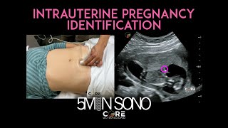 Intrauterine Pregnancy Identification with Point-of-Care Ultrasound (5MS)