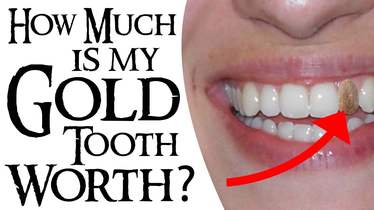 How Much Is My Gold Tooth Worth?