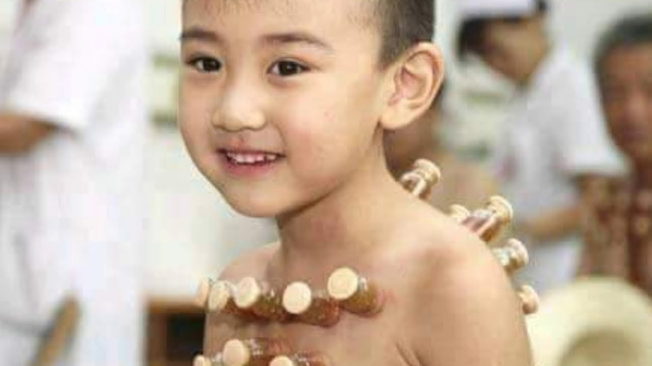 Cupping Therapy For Kids I Fire Cupping Therapy I Dry Cupping Massage