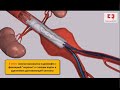 Стентирование аорты в брюшном отделе фенестрированным стент-графтом и стентирование почечных артерий