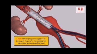 Стентирование аорты в брюшном отделе фенестрированным стент-графтом и стентирование почечных артерий