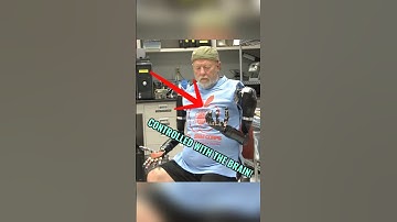 The Prosthetic That’s Controlled With the Brain🧠