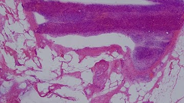 Sentinel Lymph Node in the treatment of Breast Cancer