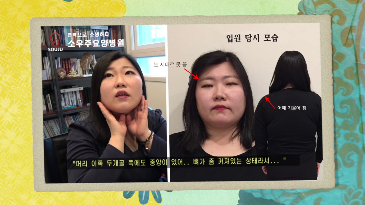 다골성 섬유성 형성이상 치유사례 - YouTube