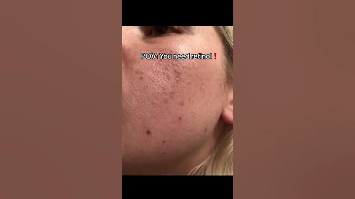 Do you NEED TO START RETINOL ALREADY?!! #skincareroutine #skincare - DayDayNews