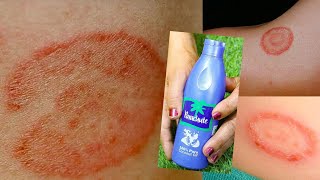 सिर्फ 2 दिन में दाद खाज खुजली (Eczema) को जड़ से खत्म कर देगा यह घरेलू नुस्खा Ringworm Treatment